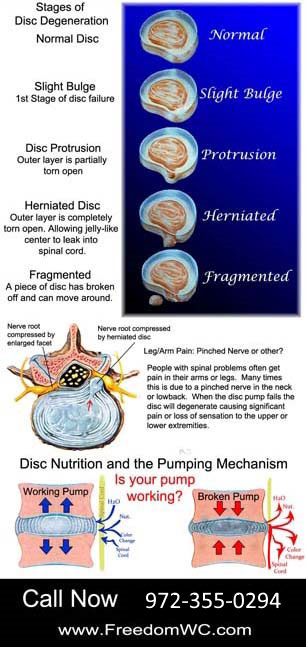 Chiropractic Flower Mound TX Stages of Disc Degeneration