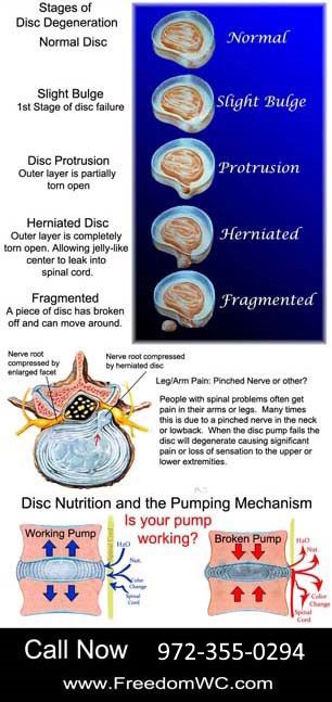 Chiropractic Flower Mound TX Stages of Disc Degeneration Chiropractic Flower Mound TX Stages of Disc Degeneration